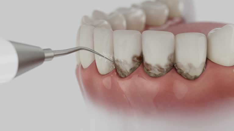 Reliable Dental Implants contractor in Carrollton, MO by Smile Center Dentistry
